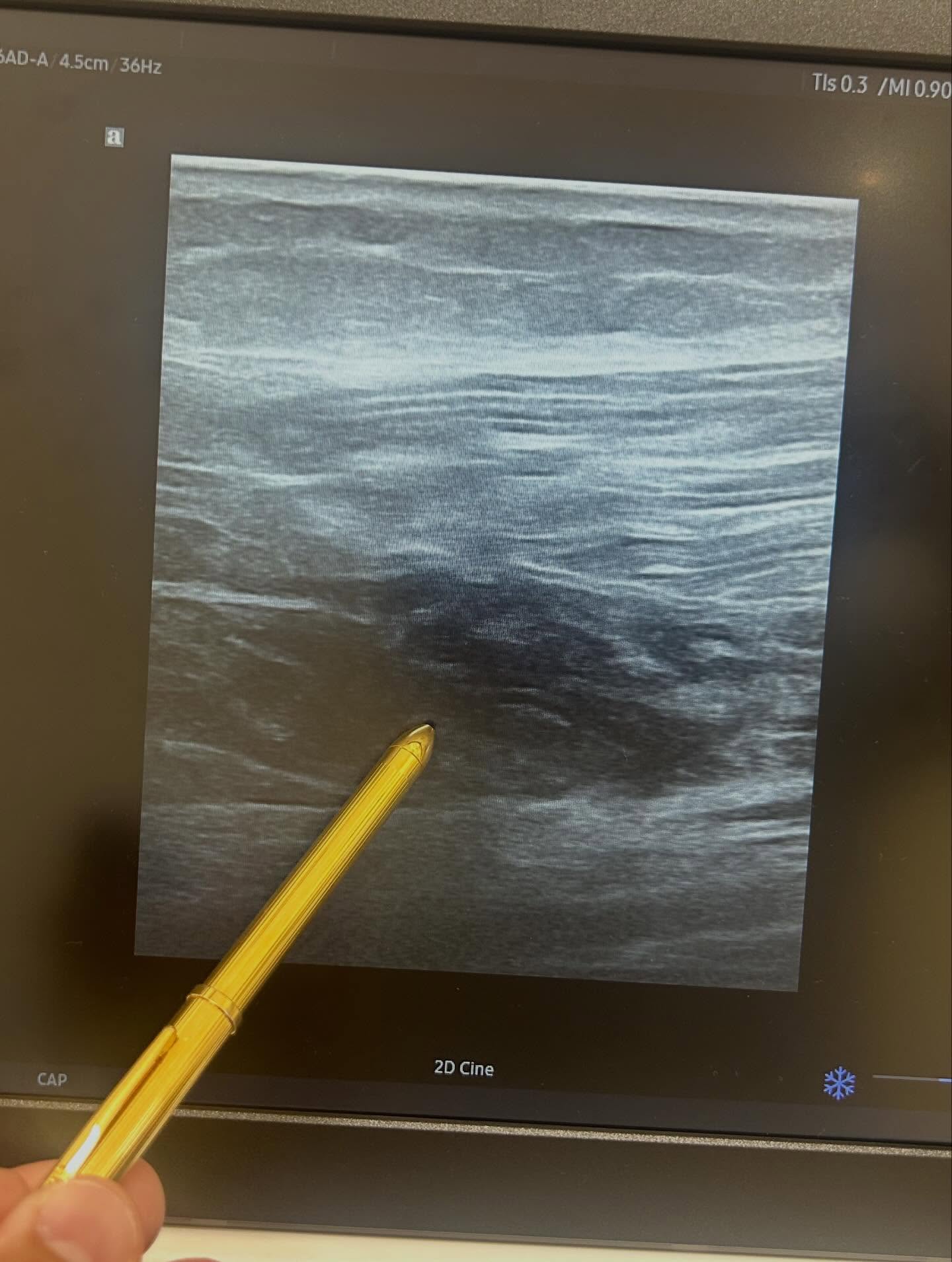 下関市内の、みよし鍼灸整骨院で撮影されたハムストリングスの肉離れのエコー写真